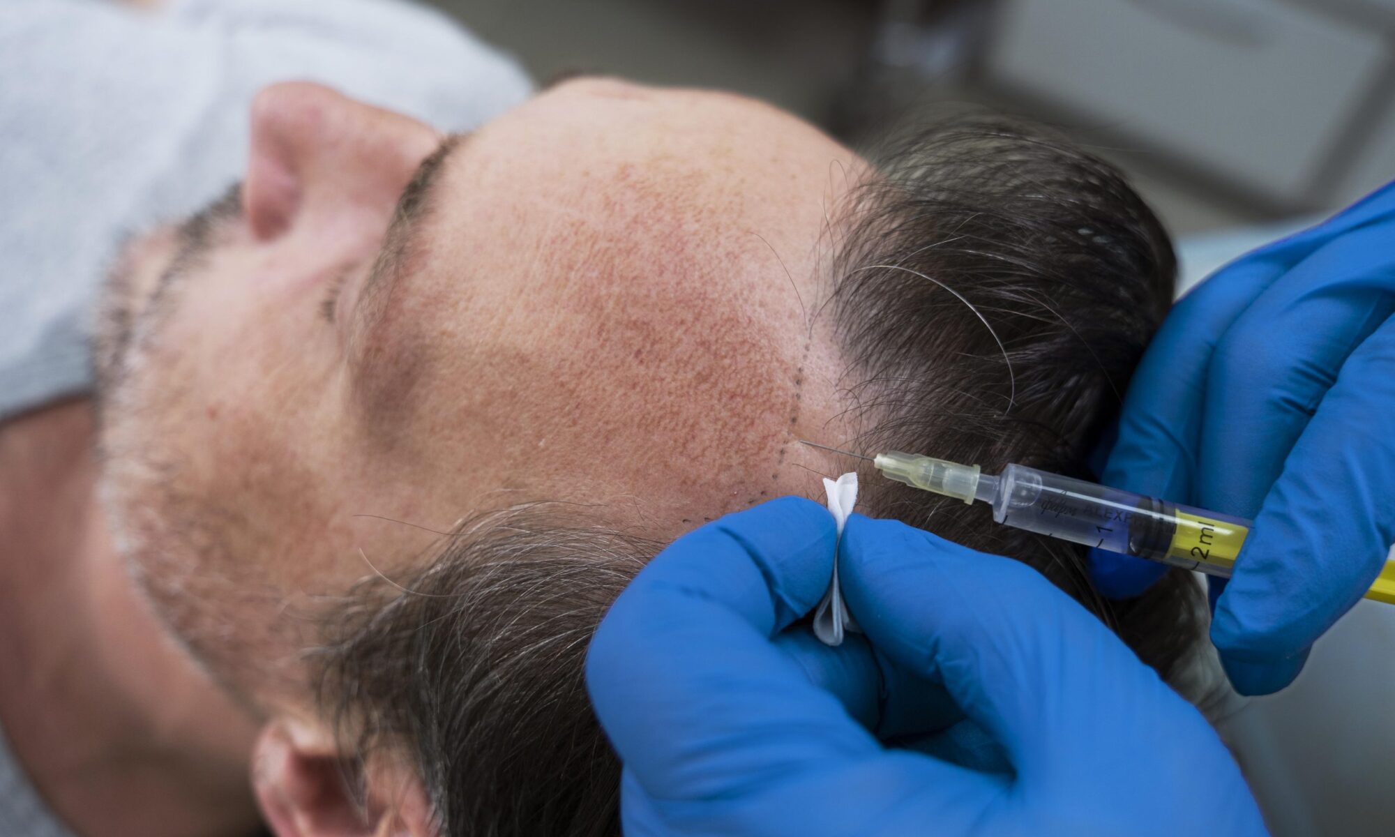 hair Transplant