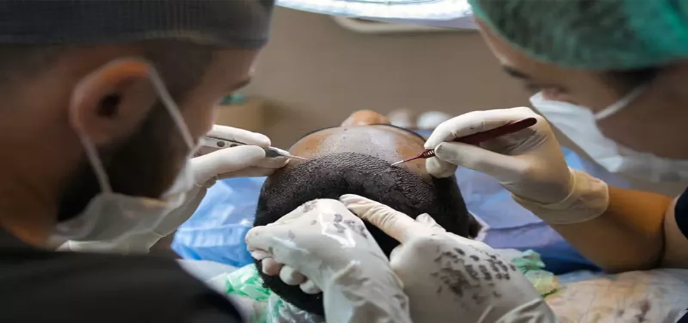 Avoiding Hair Transplant Mistakes: A Comprehensive Guide