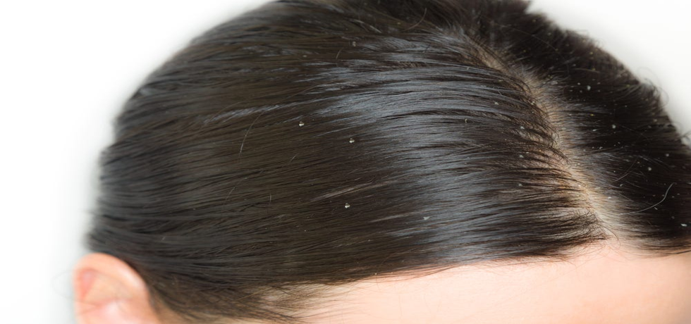 Effective Dandruff Solutions: Home & Professional Tips