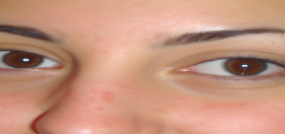 Say Goodbye to Frown Lines with The Skin Artistry’s Dermal Filler Treatment