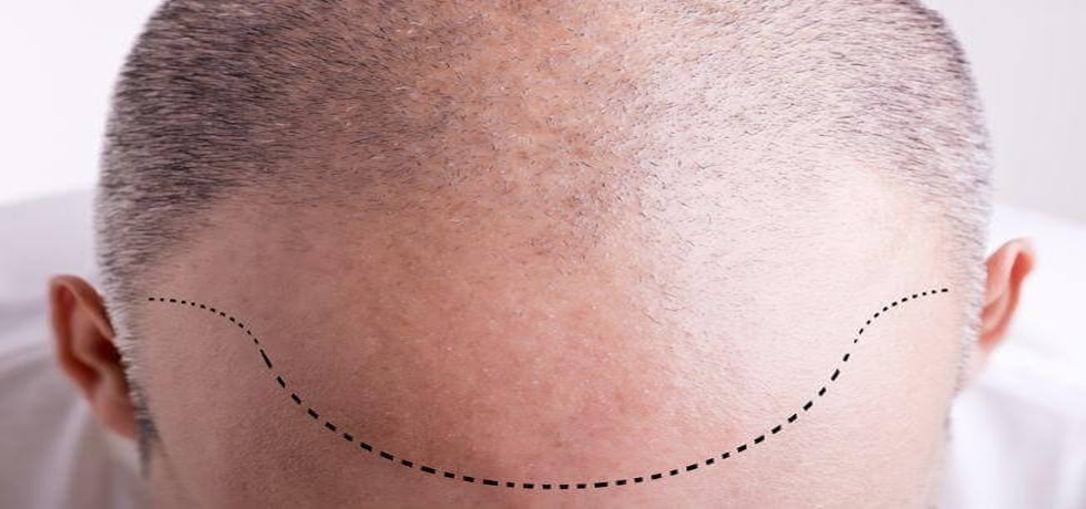 The Ultimate Hair Transplant Care Guide