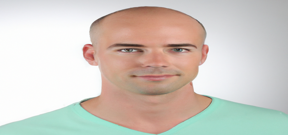 Understanding Male Pattern Baldness: Causes, Symptoms, and Solutions