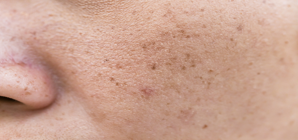 Understanding Pigmentation vs. Melasma: Unveiling the Skin Differences