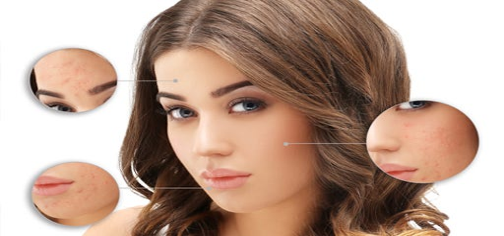 Understanding Post Inflammatory Hyperpigmentation: Causes, Signs, and Treatments