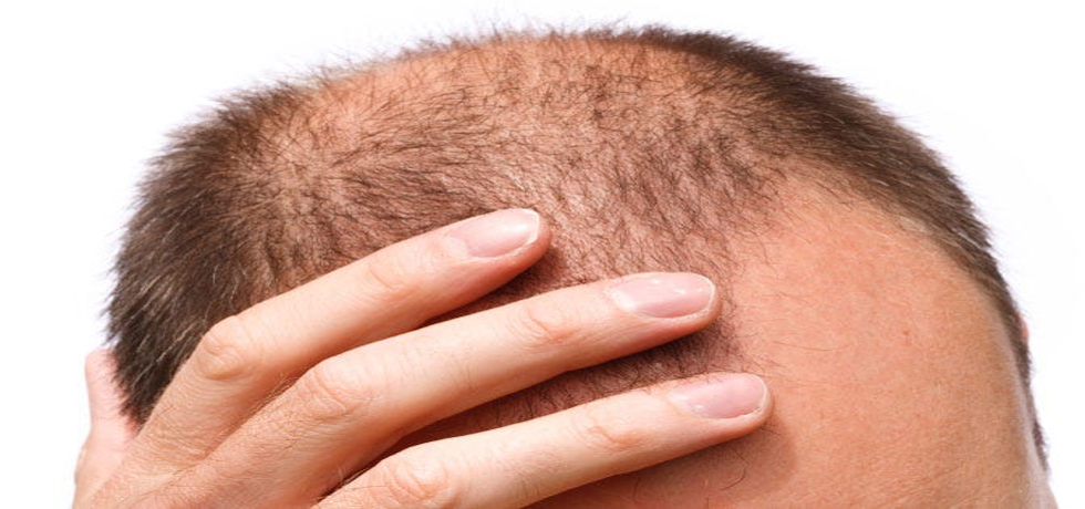 Unlock the Secret to Permanent Hair Regrowth