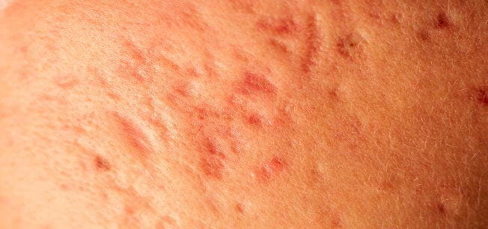 Unveiling the Truth About Acne Scars: Can They Really Disappear?