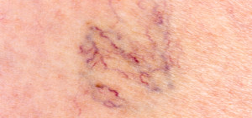 Unveiling the Truth About Spider Veins
