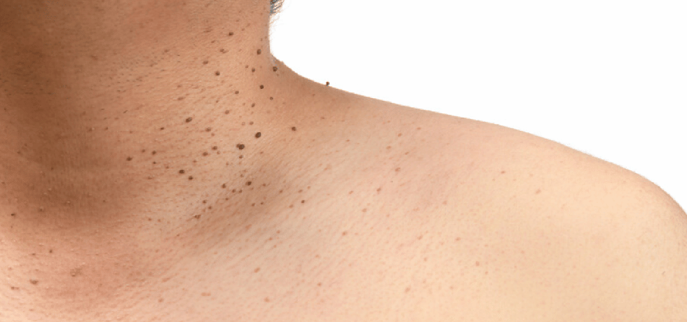 Removing Skin Tags on the Neck: Your Guide to a Smoother Neckline